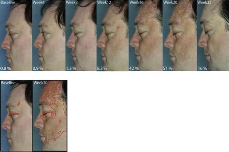 Rapid Skin Repigmentation On Oral Ruxolitinib In A Patient With