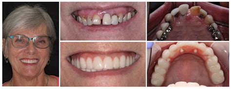 All On Four Dental Implants Knoxville Tn Implant Dentist