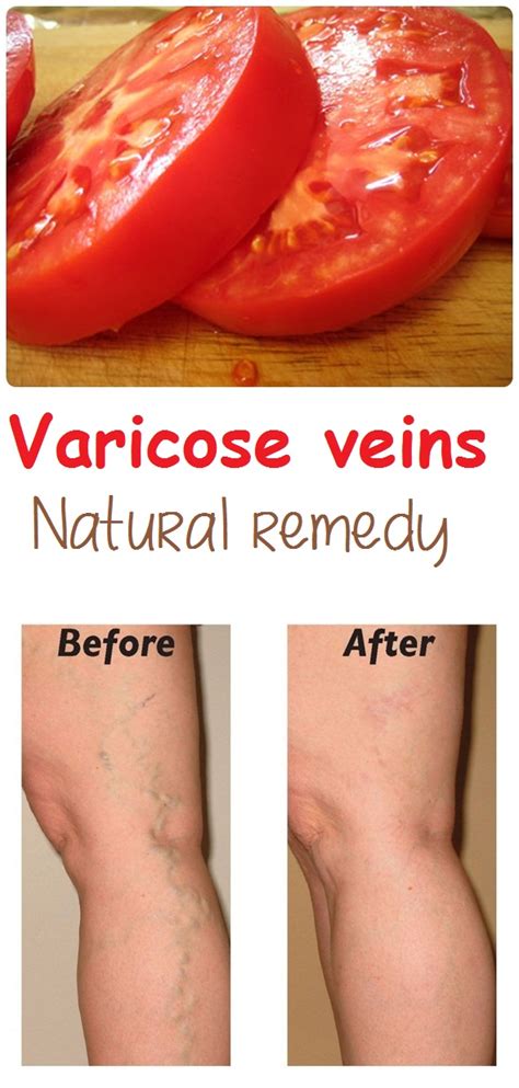 Varicose Veins Natural Remedy Top 5 Diy