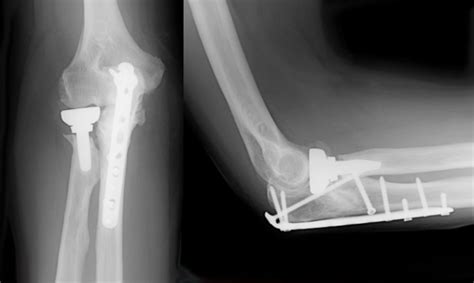 Complex Elbow Fracture Surgery Arm Docs