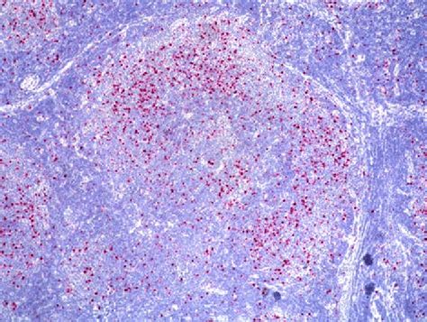 Lymph Node Follicular Lymphoma With Marginal Zone Differentiation The