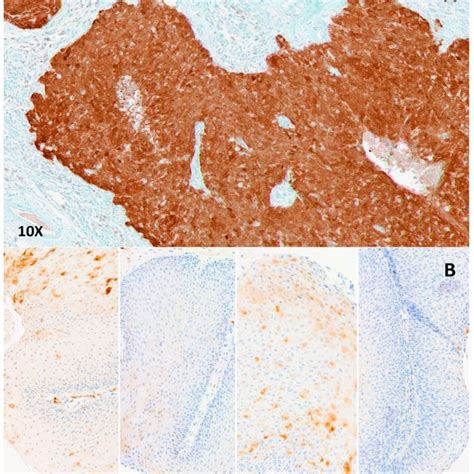 Examples Of P16 Immunostaining A Positive Immunostaining On An
