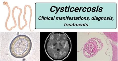 Cysticercosis Clinical Manifestations Diagnosis Treatment