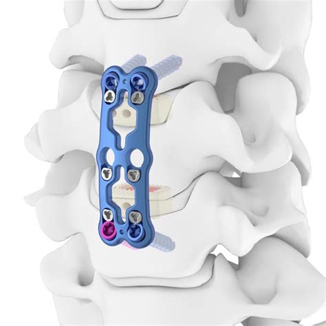 Anterior Cervical Spine Plate Ⅲanterior Cervical Solutions
