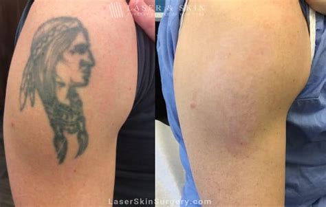 Share More Than Skin Removal Tattoo In Cdgdbentre