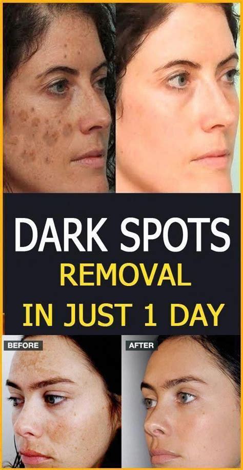 How To Get Rid Of Darkish Spots On Encounter Right Away