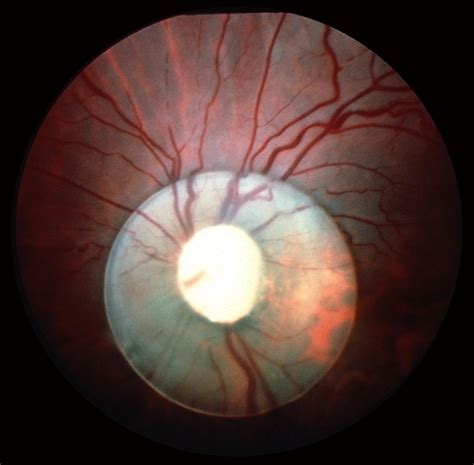 Traumatic Lens Dislocation Over Disc Retina Image Bank