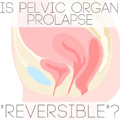 Pelvic Prolapse Telegraph