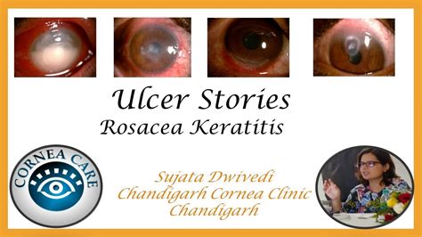 Ulcer Stories 1 Rosacea Keratitis Part 1 Youtube