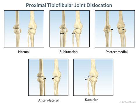 Proximal Tibiofibular Joint Dislocationsymptomscausestreatment Cold