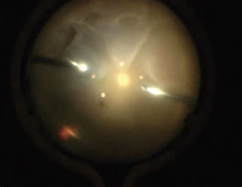 Vitrectomy For Rhegmatogenous Retinal Detachment Secondary To Acute