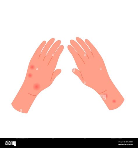 Human Hands Covered With Red Rash Allergic Itchy Reaction Atopic