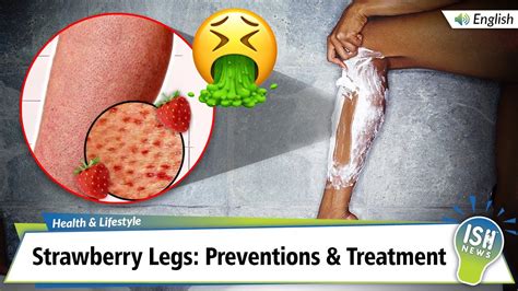 Strawberry Legs Preventions And Treatment Youtube