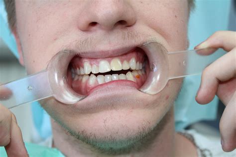 Patient KK | Dr PLR Louw - Specialized Dental Centre