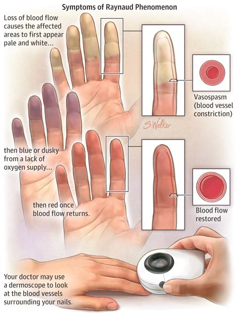 Raynauds Phenomenon And How To Manage It Hubpages