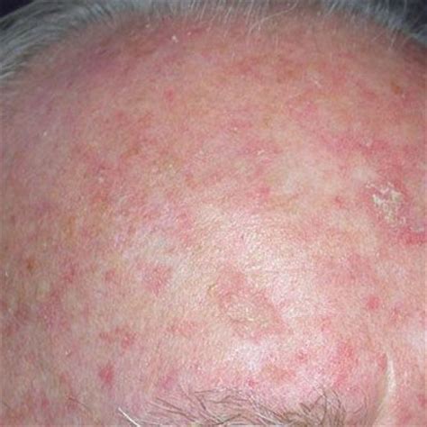 What does actinic keratosis look like. Actinic Keratoses (AK) - Miller Family Dermatology