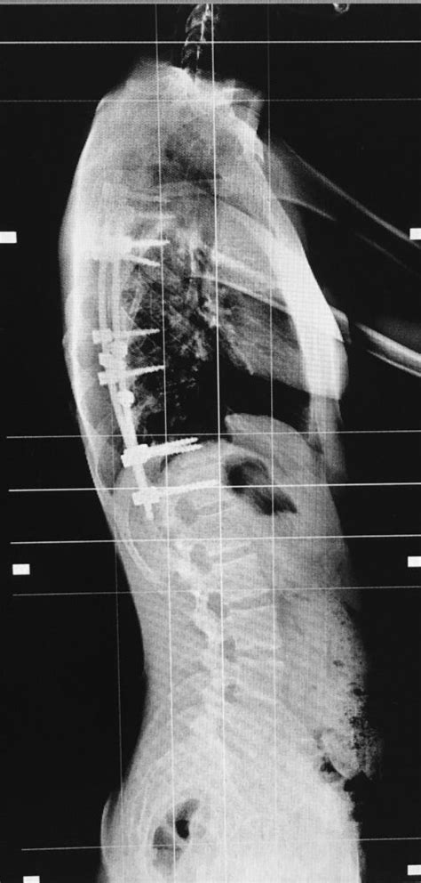 AIS - scoliosi idiopatica dell'adolescente FU 5 anni ...
