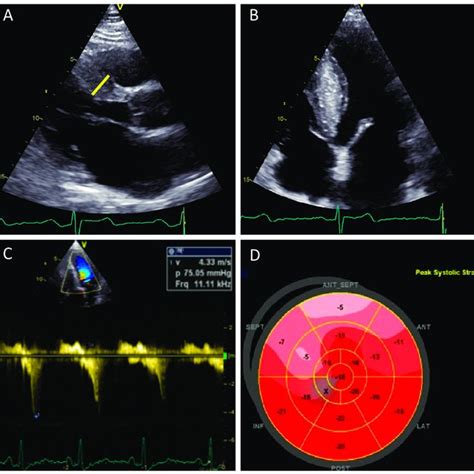 The Role Of Transthoracic Two Dimensional Echocardiography In The