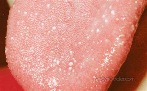 Can Allergies Cause Bumps On Back Of Tongue