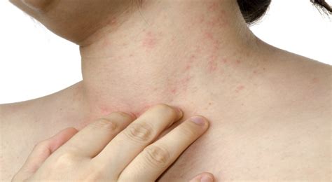 What Is Smallpox Symptoms Causes Risk Factors And Diagnosis