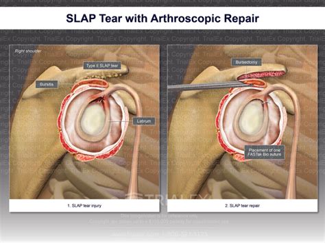 SLAP Tear With Arthroscopic Repair Trial Exhibits Inc