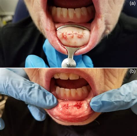 Dry Surgical Field Minor Salivary Gland Harvest Using A Chalazion Clamp