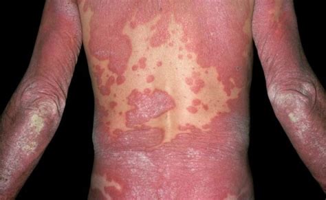 Scabies Infection Associated With Increased Psoriasis Risk