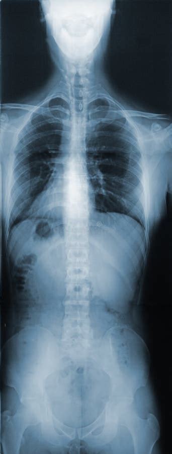 X Ray Of The Torso Stock Image Image Of Neck Bones Orthopedics 2234465