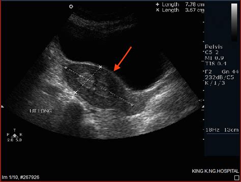 Uterine Polyps Ultrasound