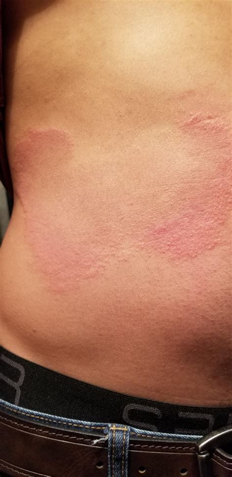 Itchy Rash On Side Of Stomach For Last 3 Days Expanding Outwards R