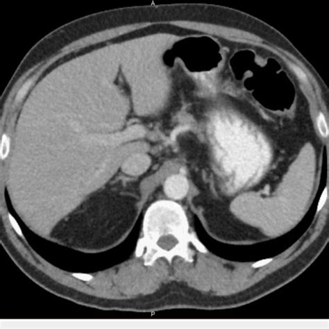 Initial Ct Scan Of Abdomen With Arrows Indicating Multiple Liver