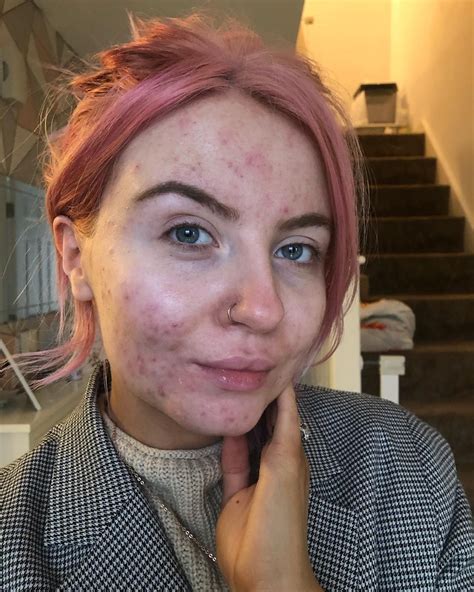 Beauty Blogger Abbie Shared A Before And After Makeup Post On Her Instagram Which Has Since
