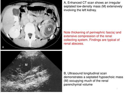 Ppt Renal Abscess Powerpoint Presentation Free Download Id1324121