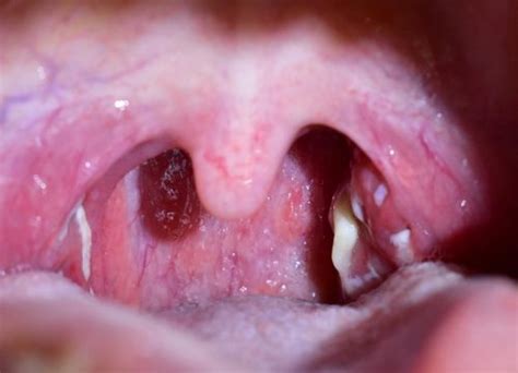 Can Sinus Drainage Cause Tonsil Stones Best Drain Photos Primagemorg