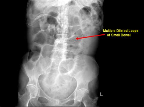Abdominal X Ray Displayed Multiple Dilated Loops Of Small Bowel
