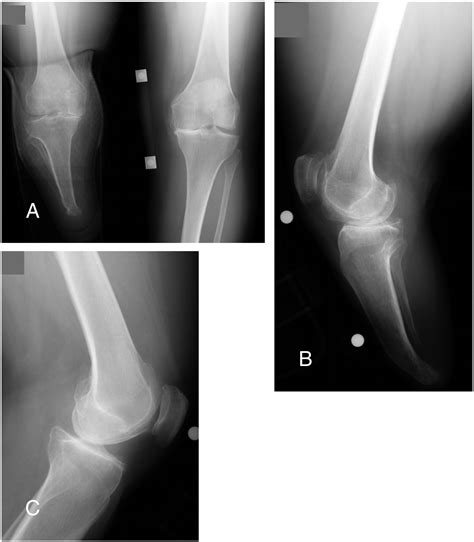 Total Knee Arthroplasty After Lower Extremity Amputation A Review Of