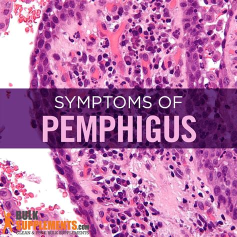 Pemphigus Symptoms Causes And Treatment By James Denlinger Medium