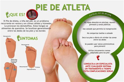 Pie De Atleta Infograf A Insteract A