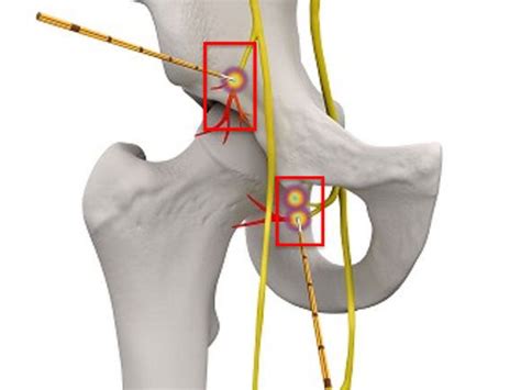 Obturator And Femoral Nerve Blocks And Radiofrequency Ablation Excel