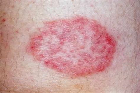 Tiny Red Blood Spots On Skin Red Spots On Legs Itchy Pictures Dots