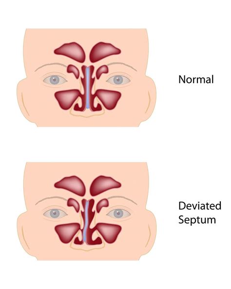 Deviated Septum Ear Nose Throat Care Center
