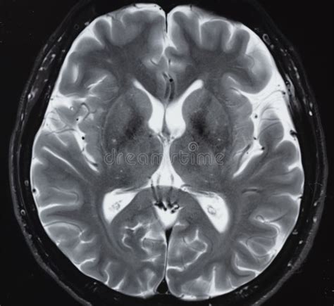 Mri Of Normal Human Brain Anatomy Stock Photo Image Of Patient