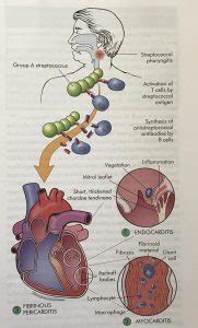 Pathophysiology and Clinical Presentation | Rheumatic Fever