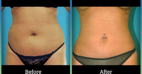 Check Out The Results From Tumescent Technique For Liposuction Before