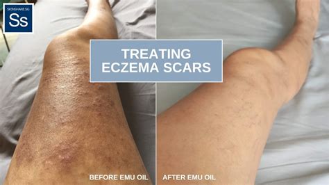 How To Lighten Eczema Scars And Prevent Further Skin Aging
