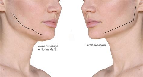 Souffrance Transition réduire contour visage acide hyaluronique