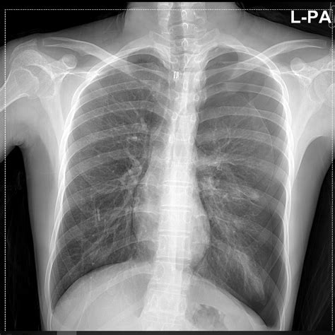 Wang w., gao r., zheng y., jiang l. 일차성 자발성 기흉, Primary spontaneous pneumothorax (PSP)