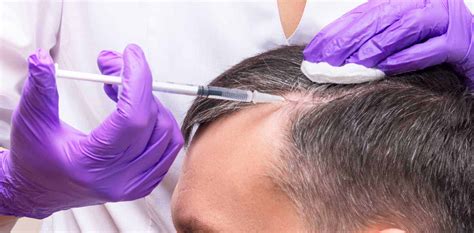 Despite being around since the 1980s, it's only recently that doctors have began using it as a therapy for alopecia. The Amazing Wonders of PRP Hair Loss Therapy - Get your ...