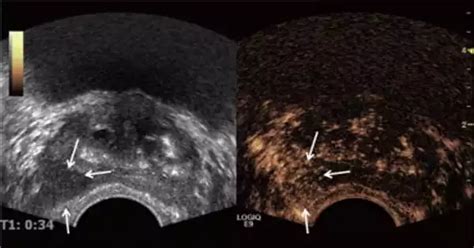 Prostate Cancer Can Be Detected Using Ultrasound Scan Assignment Point