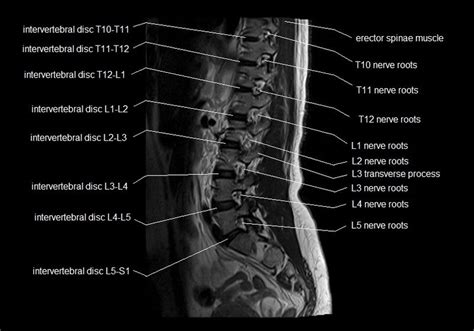 Mri Spine Anatomy Free Mri Lumbar Spine Sagittal Cross Sectional